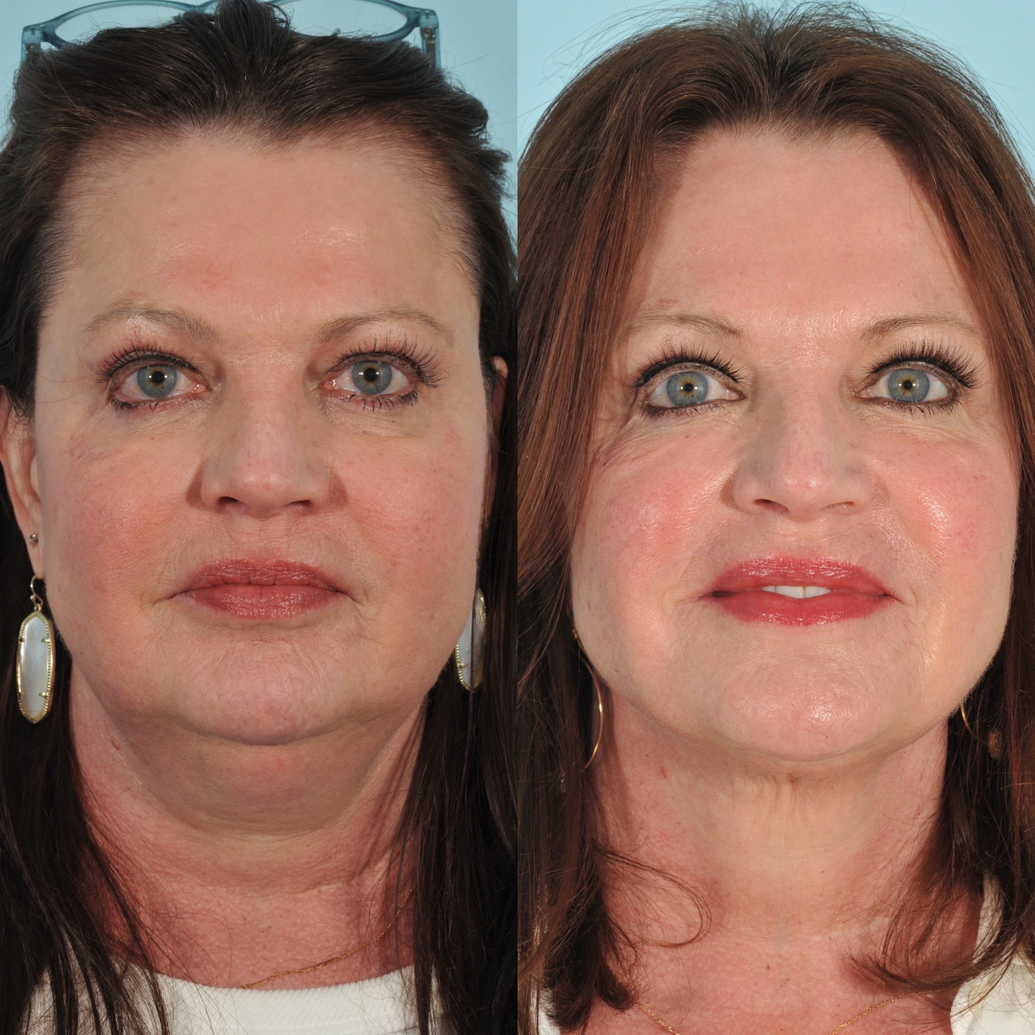 Kybella Before & After #3