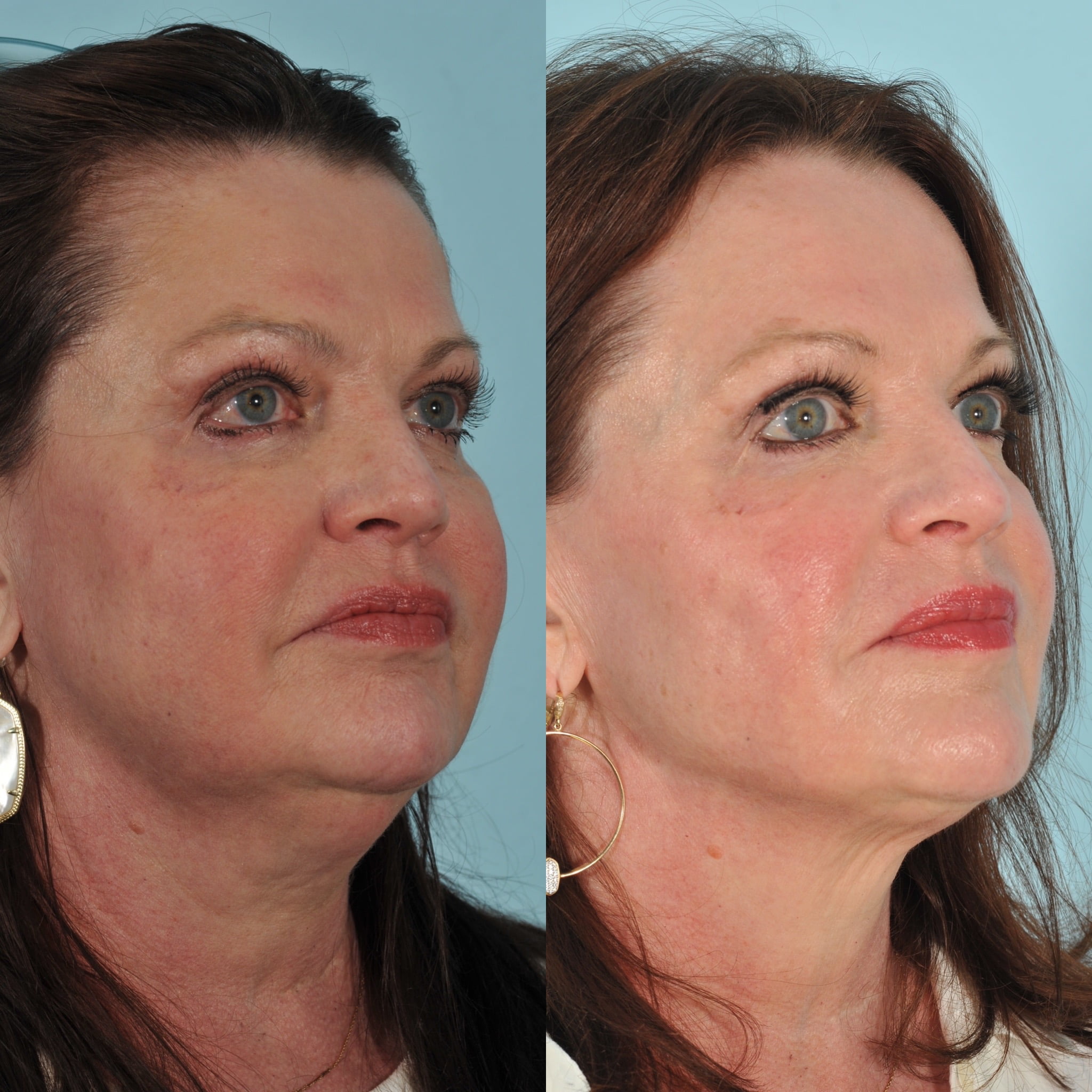 Kybella Before & After #3 image 2