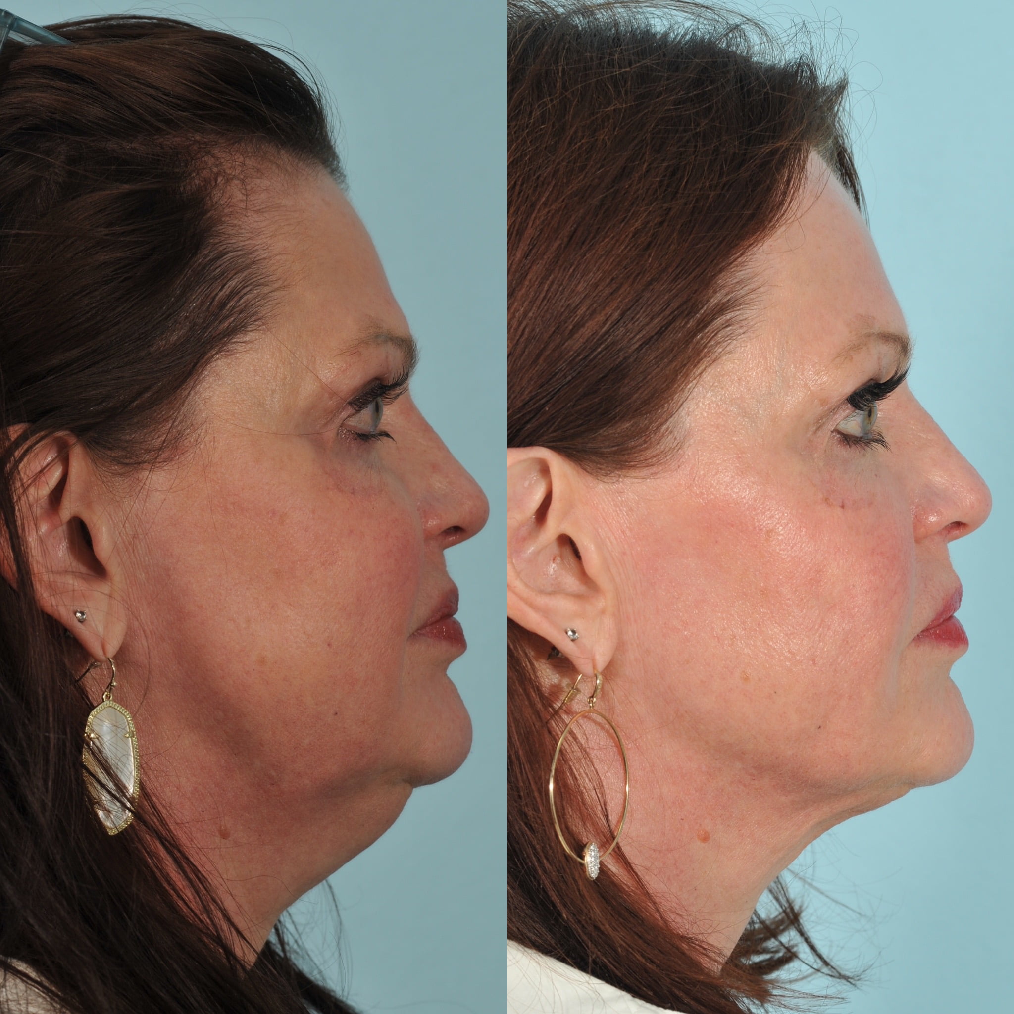 Kybella Before & After #3 image 3