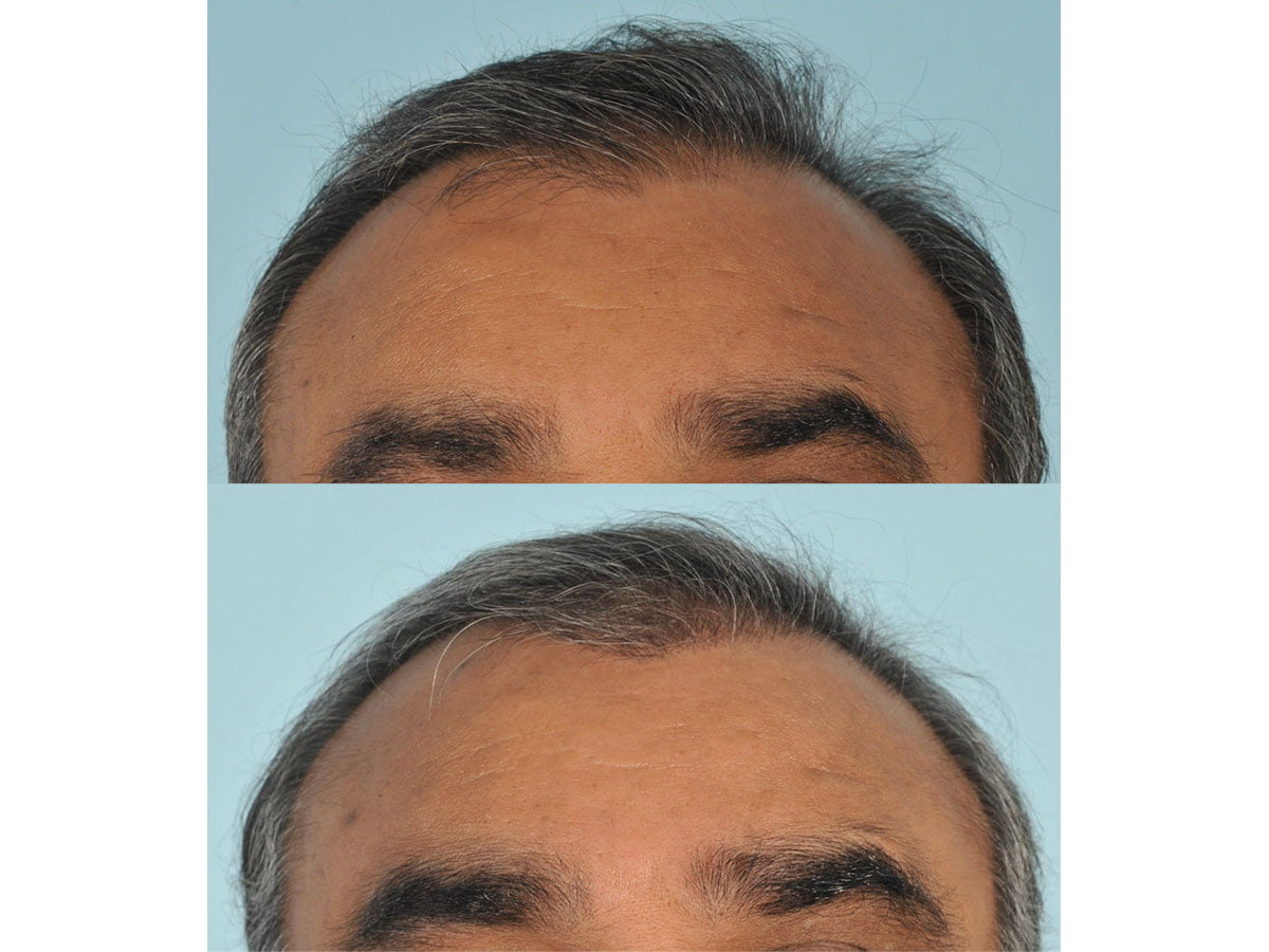 Hair Transplant Before & After #8