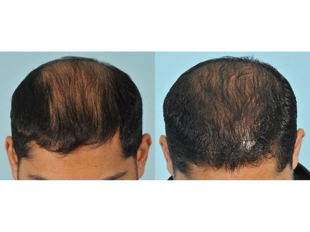 Hair Transplant Before & After #9 before and after
