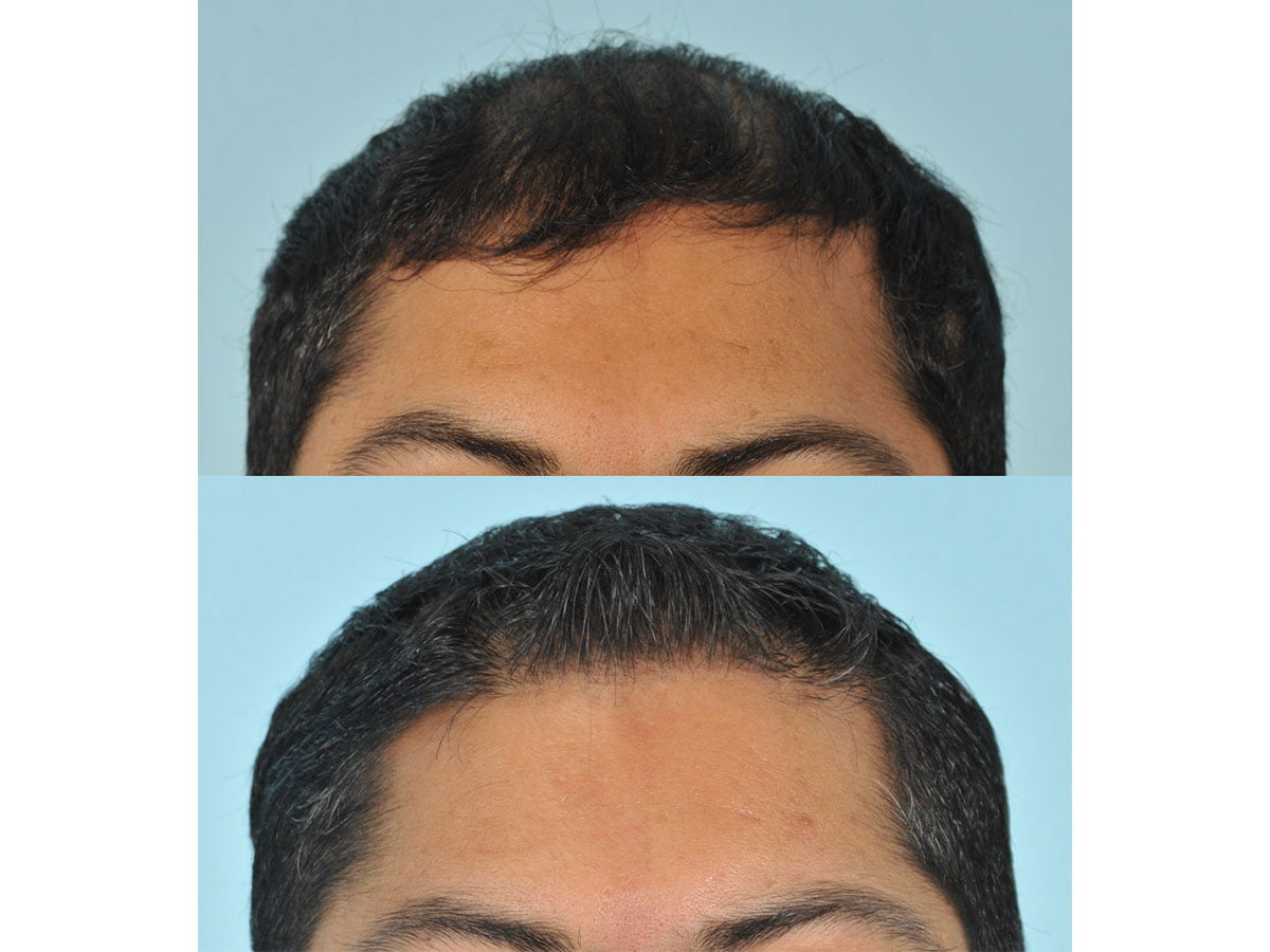 Hair Transplant Before & After #9 image 2