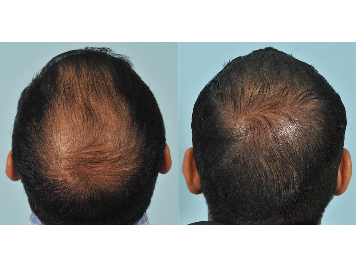 Hair Transplant Before & After #9 image 3