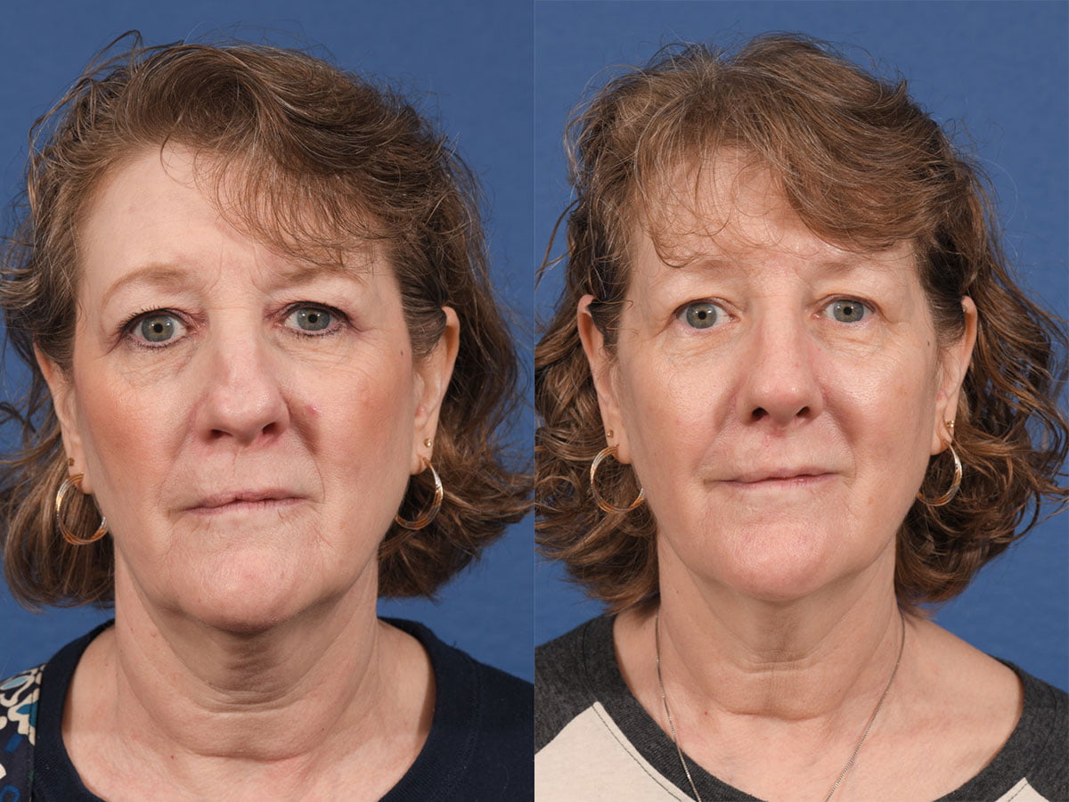 Revision Rhinoplasty Before & After #2 image 4