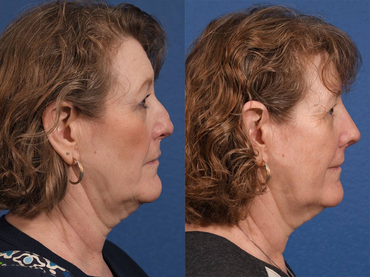 Revision Rhinoplasty Before & After #2 image 3