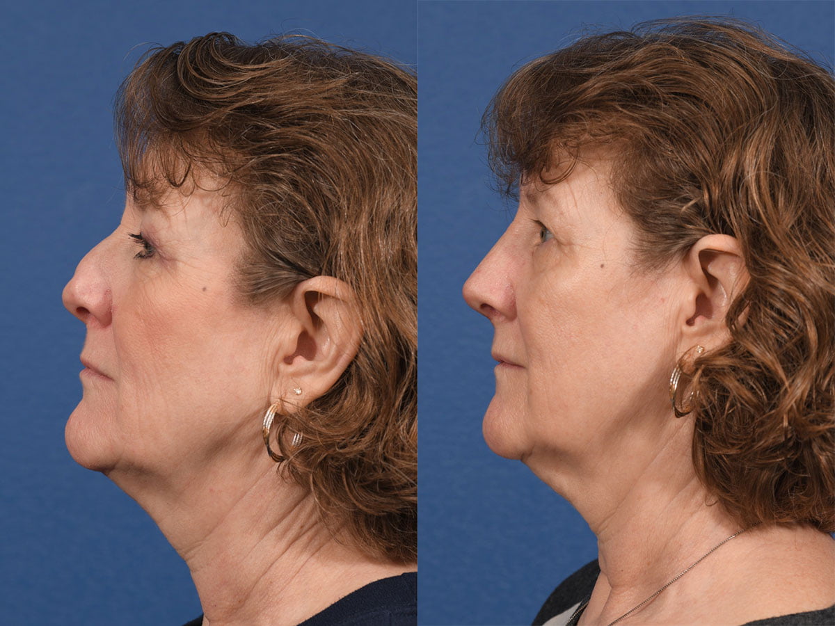 Revision Rhinoplasty Before & After #2
