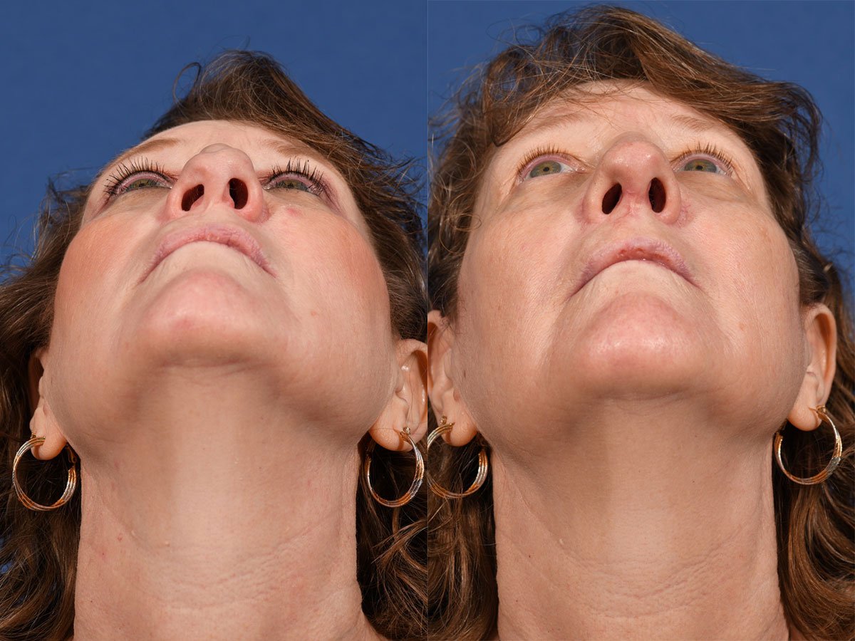 Revision Rhinoplasty Before & After #2 image 2