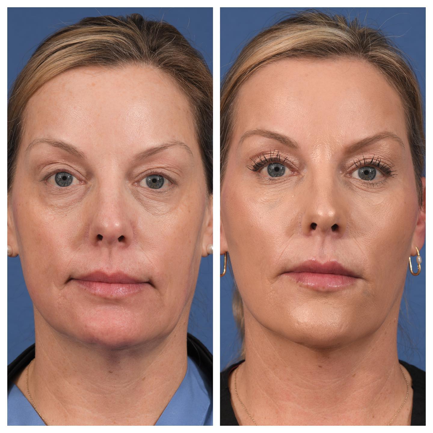 Injectables Before & After #11