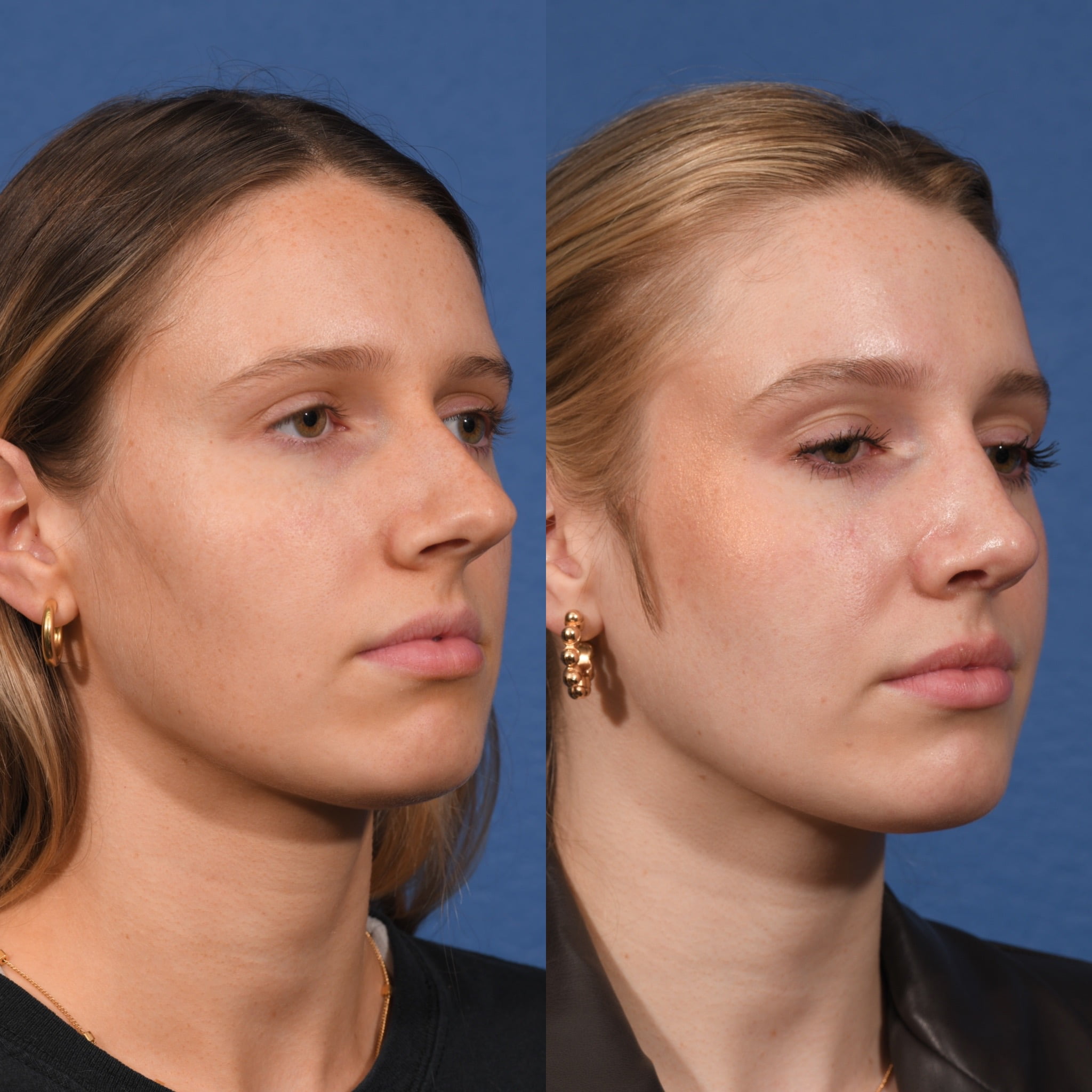 Rhinoplasty Before & After #15 image 4