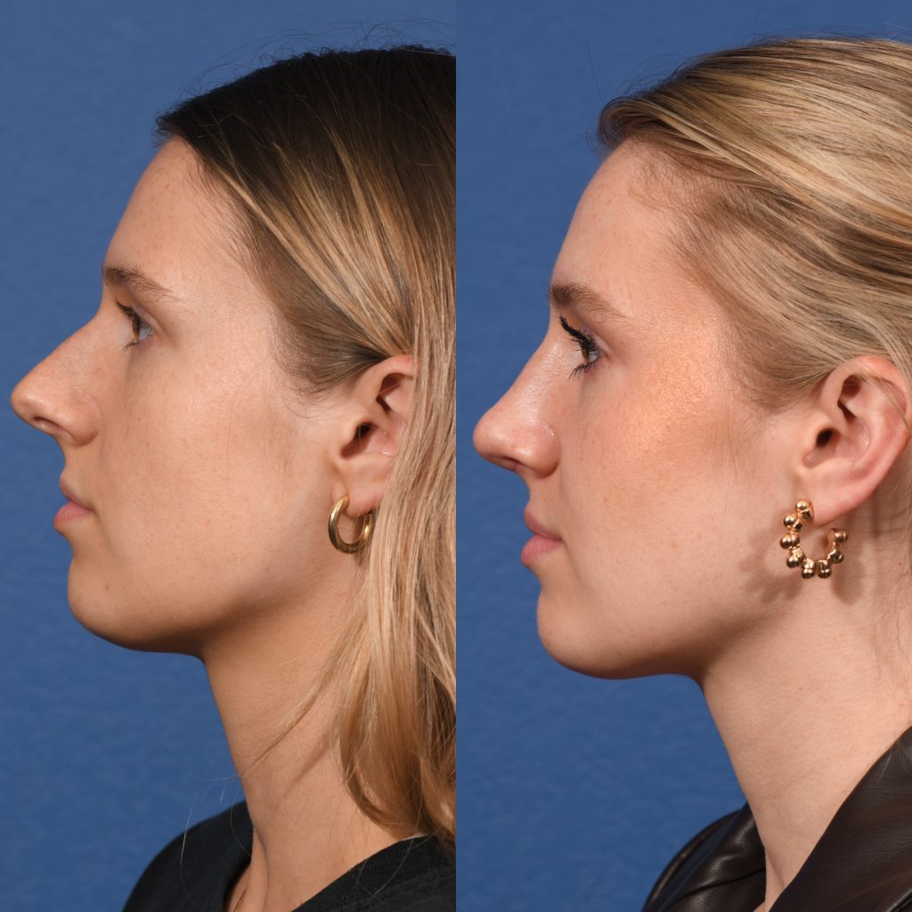 Rhinoplasty Before & After #15