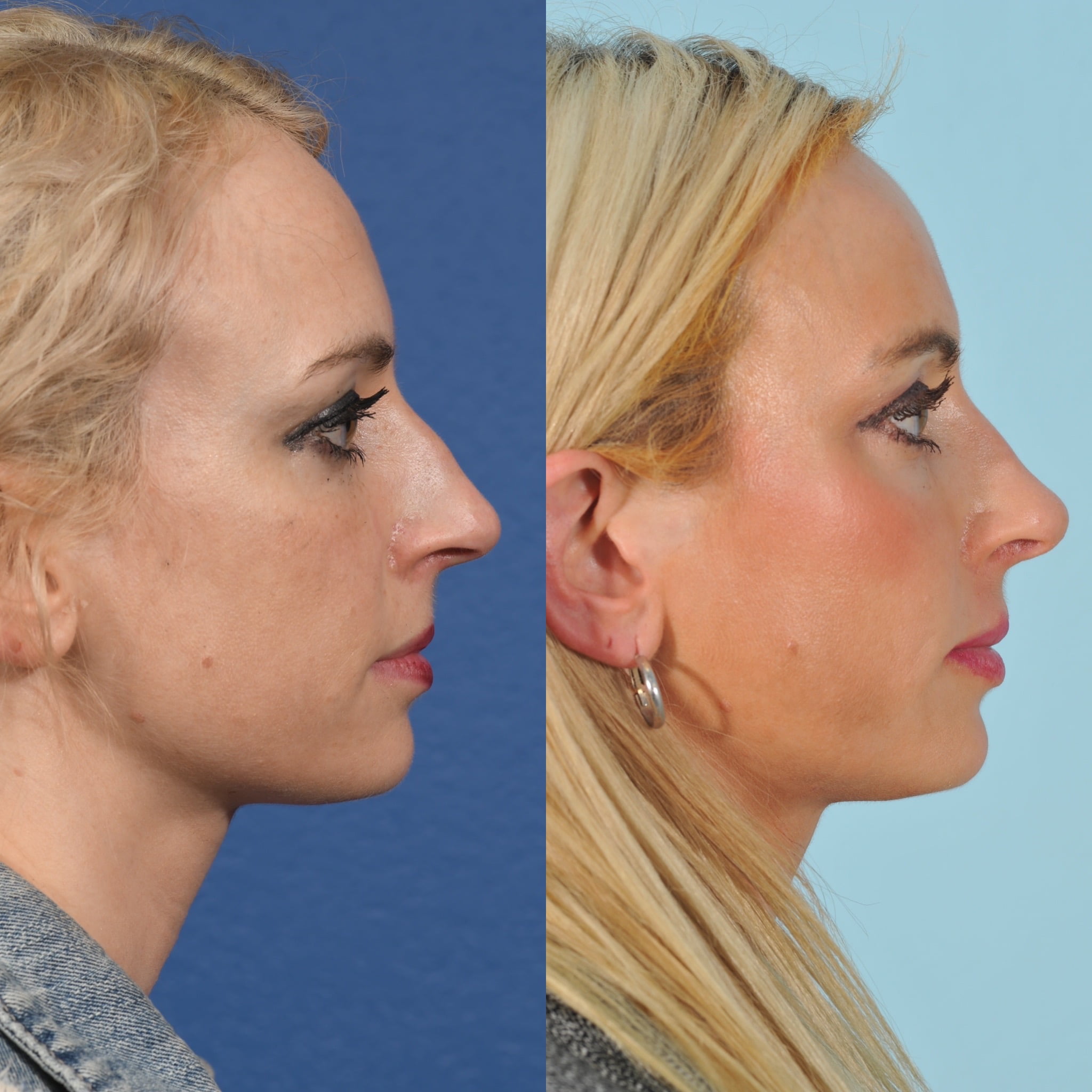 Rhinoplasty Before & After #16