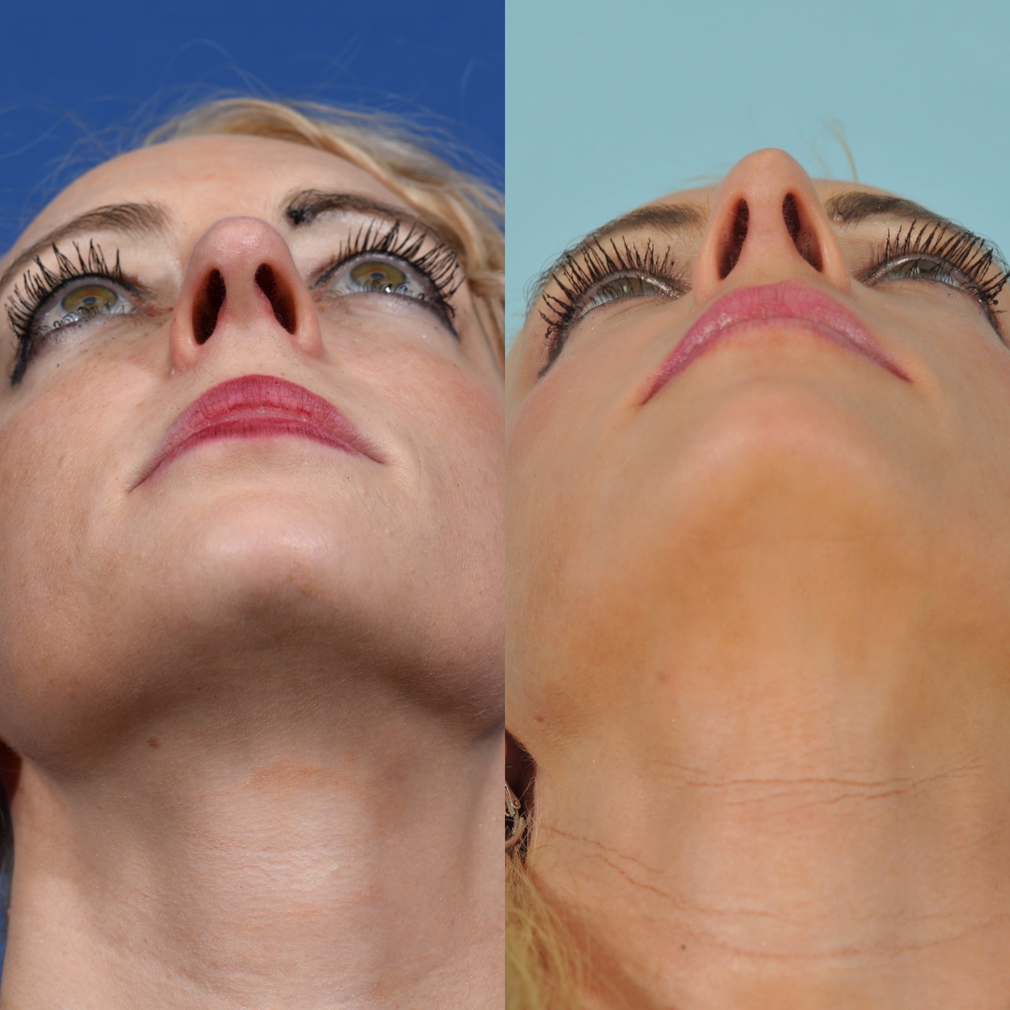 Rhinoplasty Before & After #16 image 6