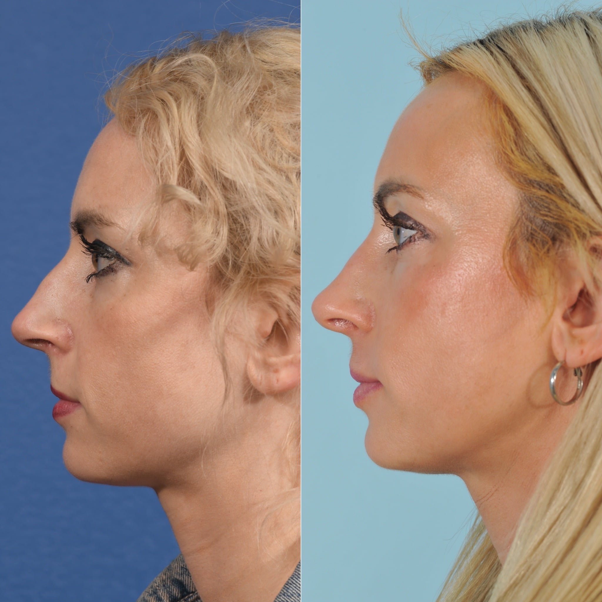 Rhinoplasty Before & After #16 image 4