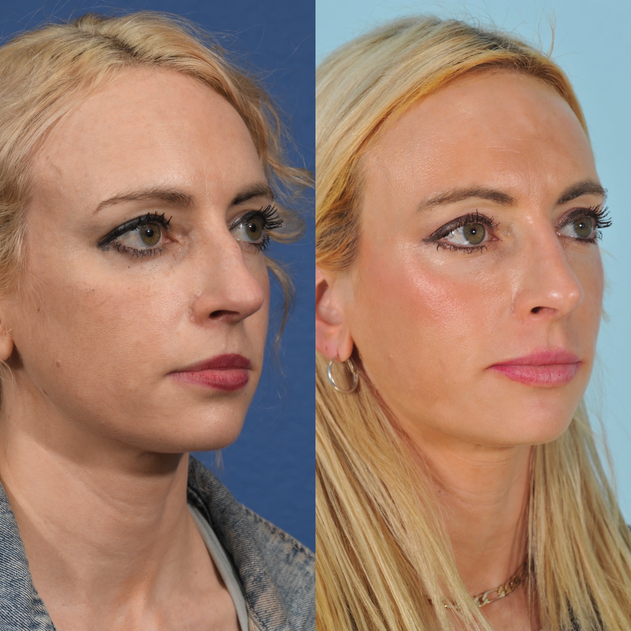 Rhinoplasty Before & After #16 image 5