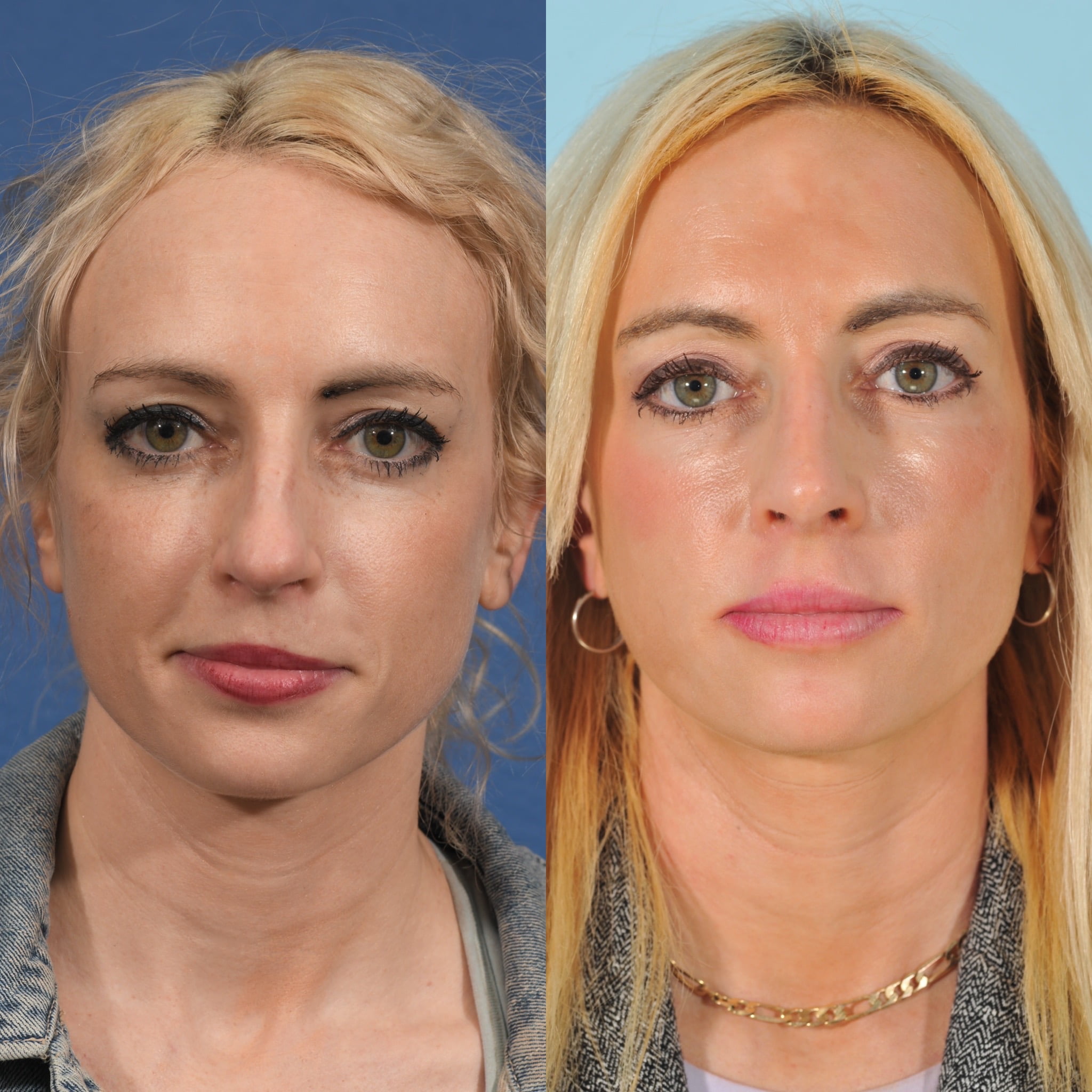 Rhinoplasty Before & After #16 image 1