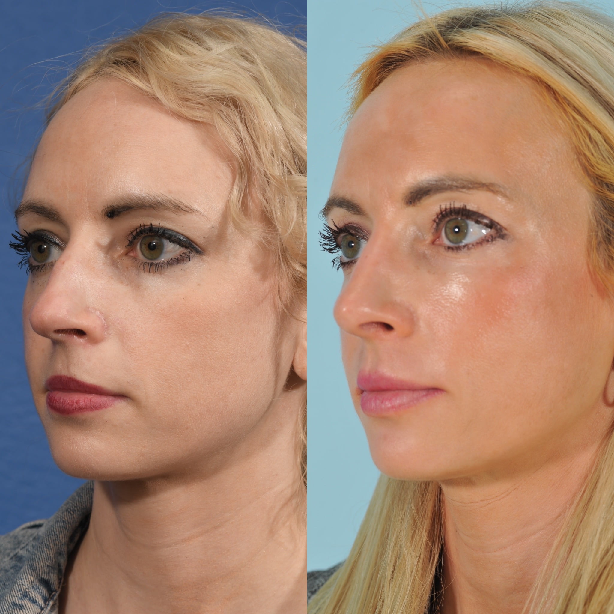 Rhinoplasty Before & After #16 image 2