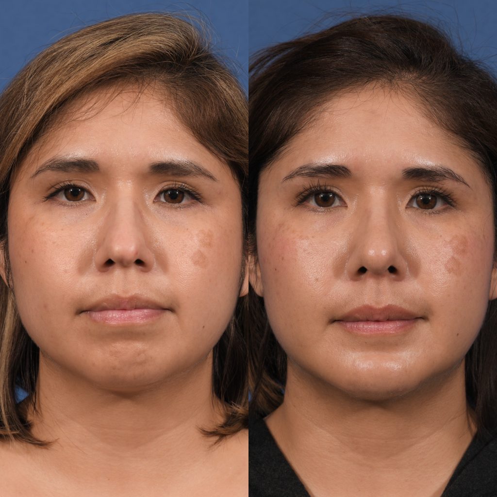 Rhinoplasty & Chin Before & After #1 before and after