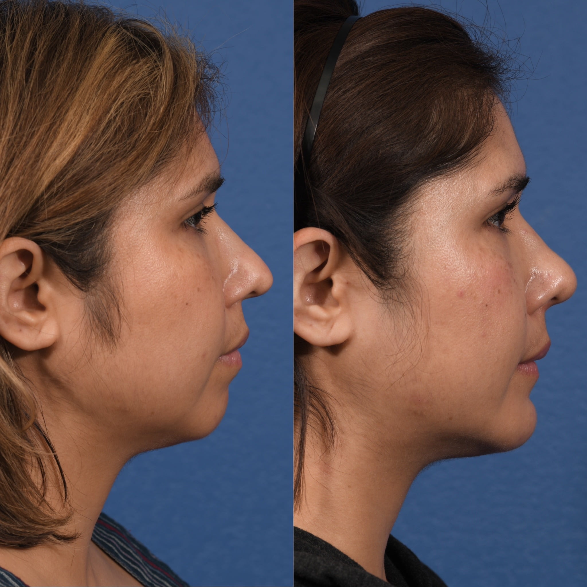 Rhinoplasty & Chin Before & After #1