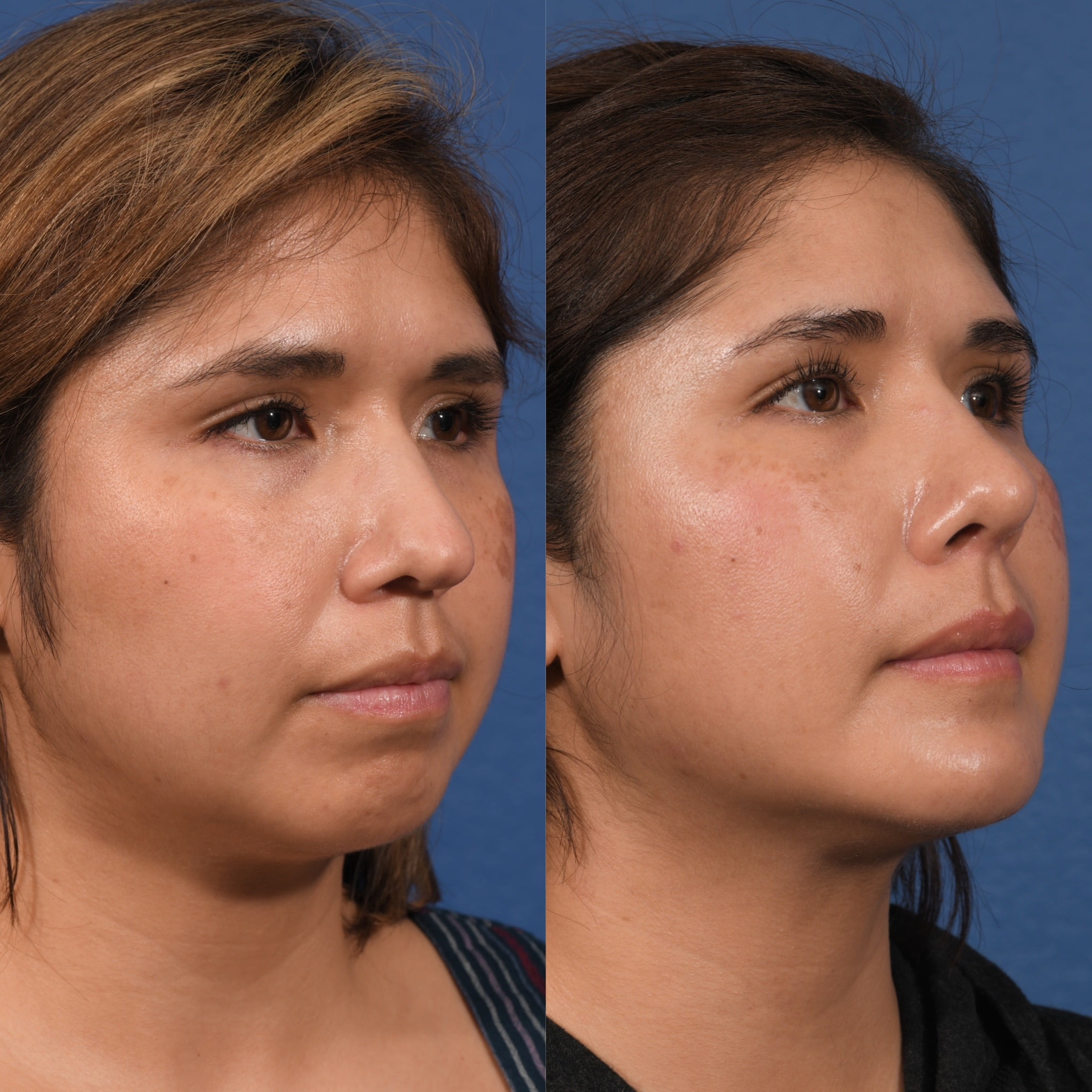 Rhinoplasty & Chin Before & After #1 image 3