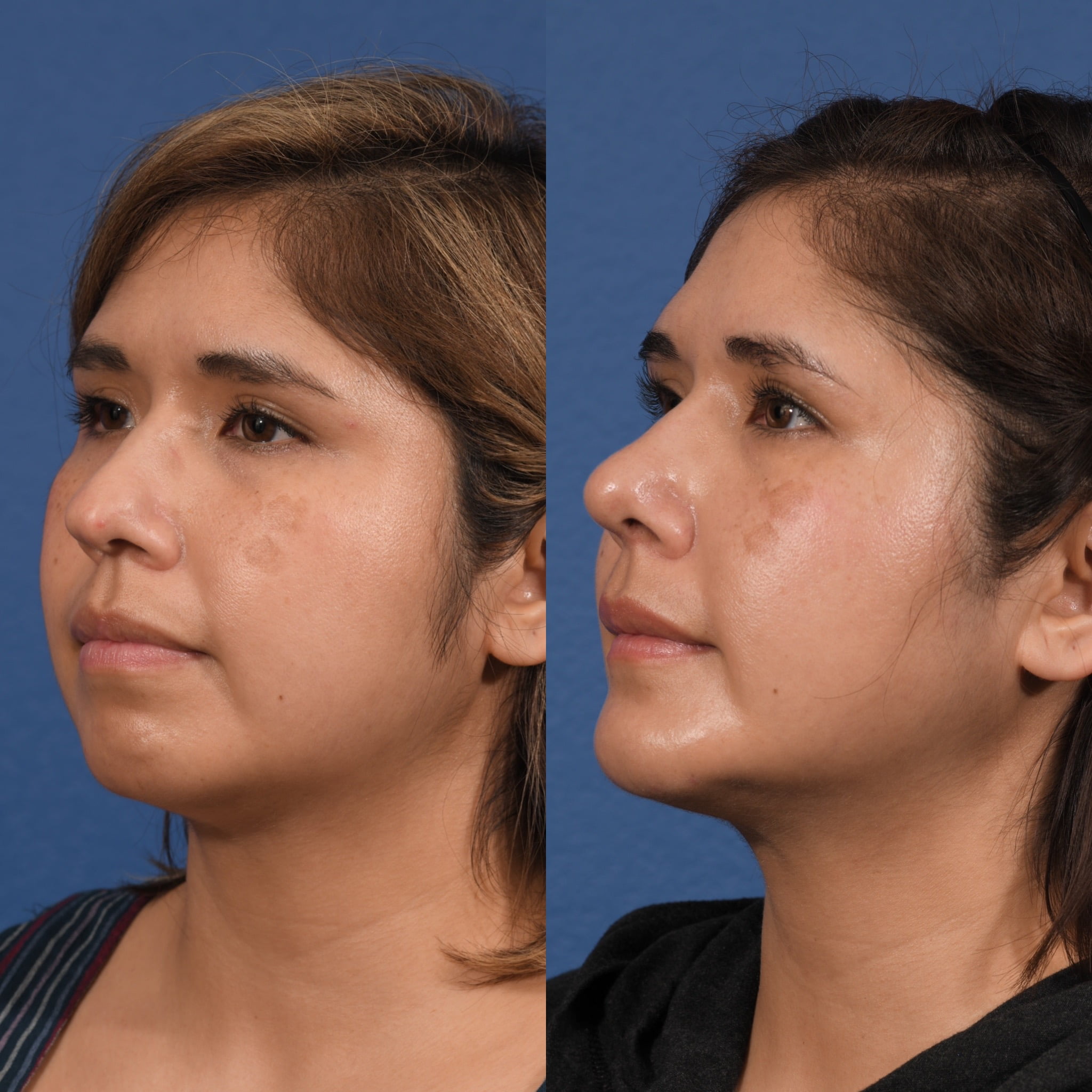 Rhinoplasty & Chin Before & After #1 image 6