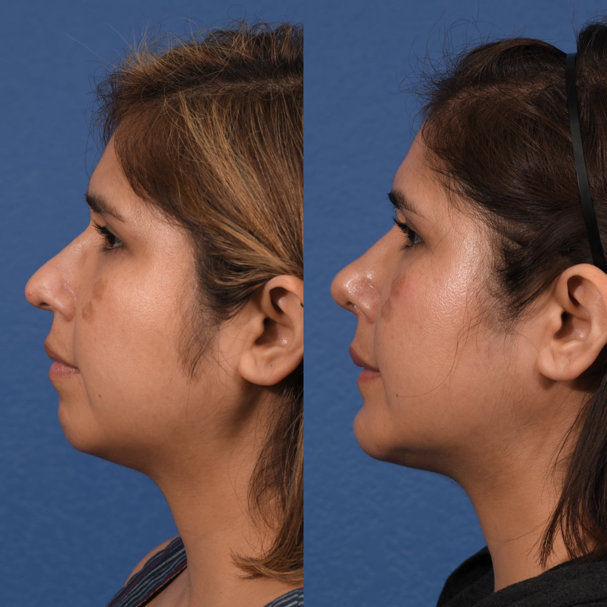 Rhinoplasty & Chin Before & After #1 image 5
