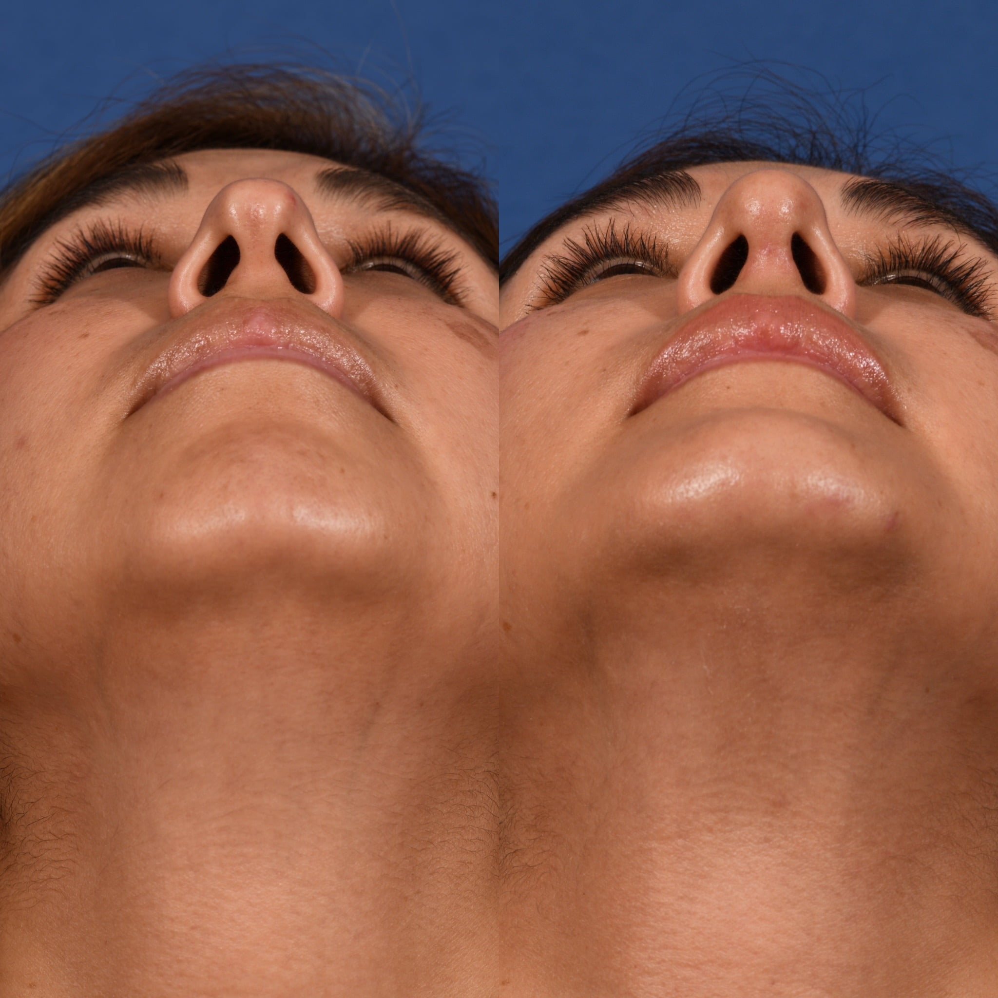 Rhinoplasty & Chin Before & After #1 image 4