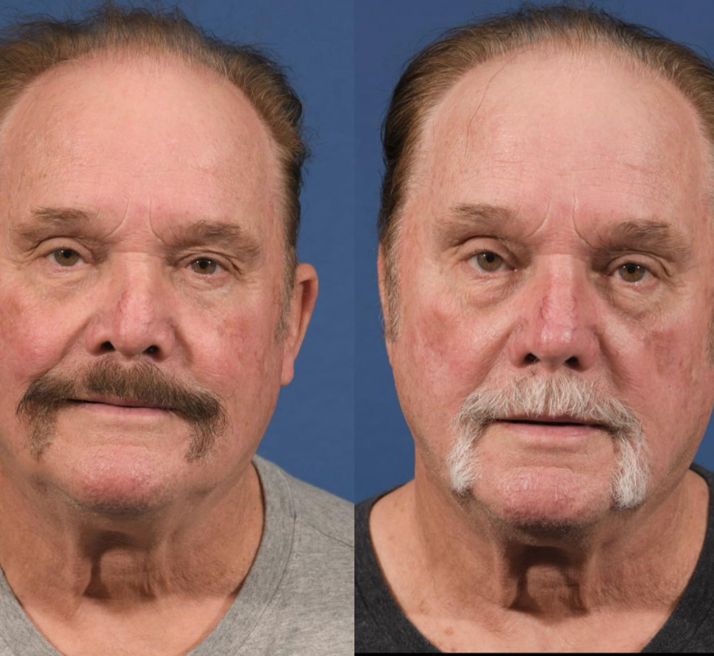 Rhinoplasty Before & After #17 image 2
