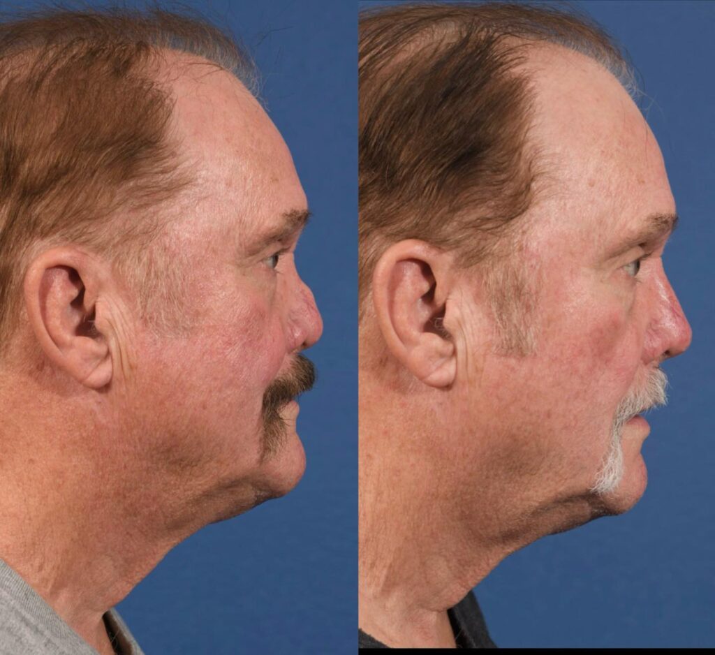 Rhinoplasty Before & After #17 before and after