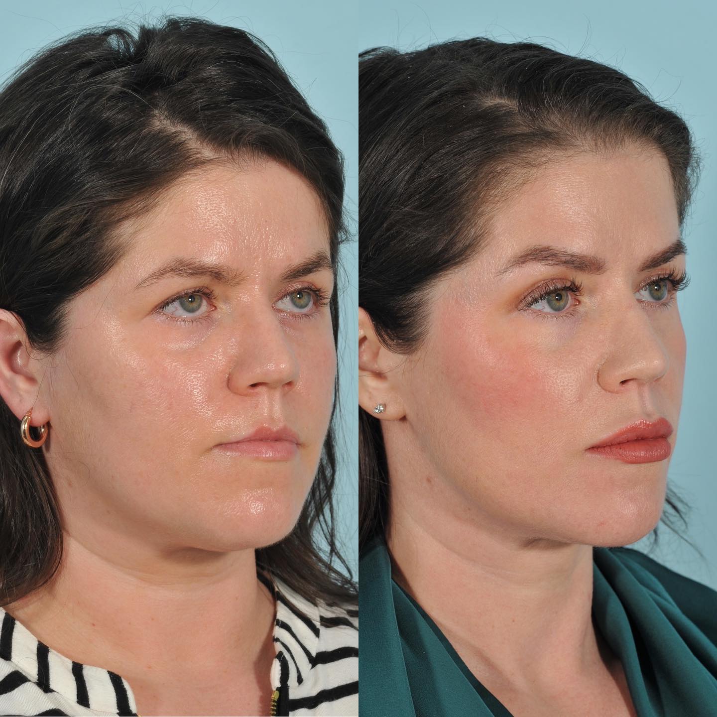 Injectables Before & After #12 image 5