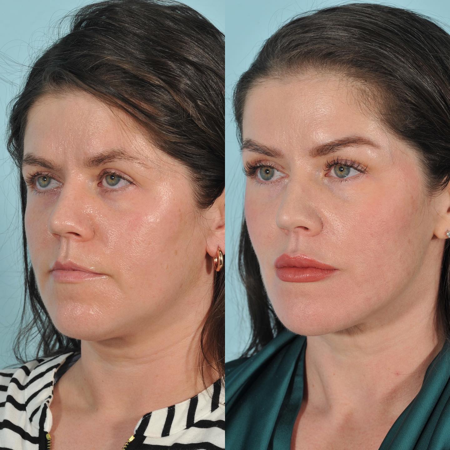 Injectables Before & After #12 image 4
