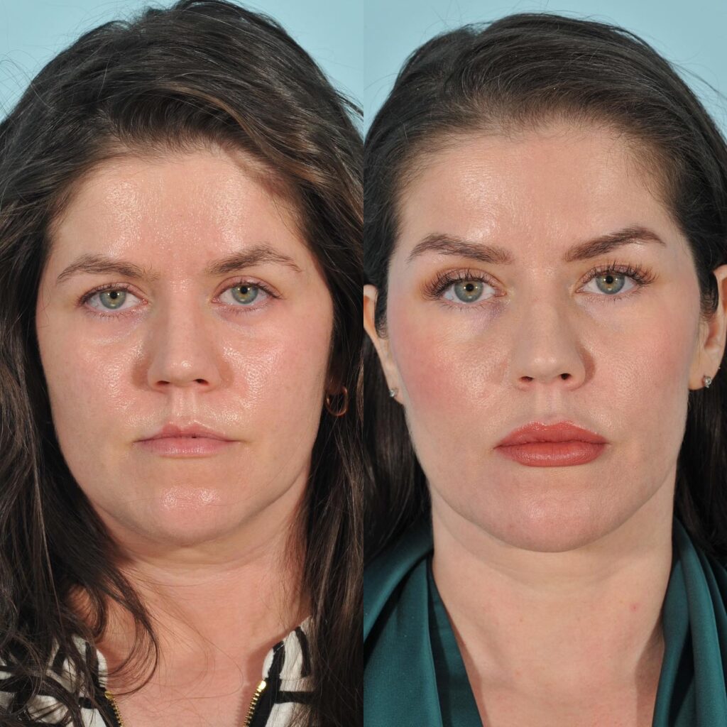 Injectables Before & After #12