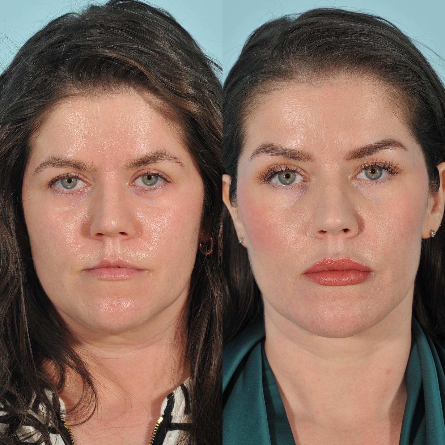 Injectables Before & After #12