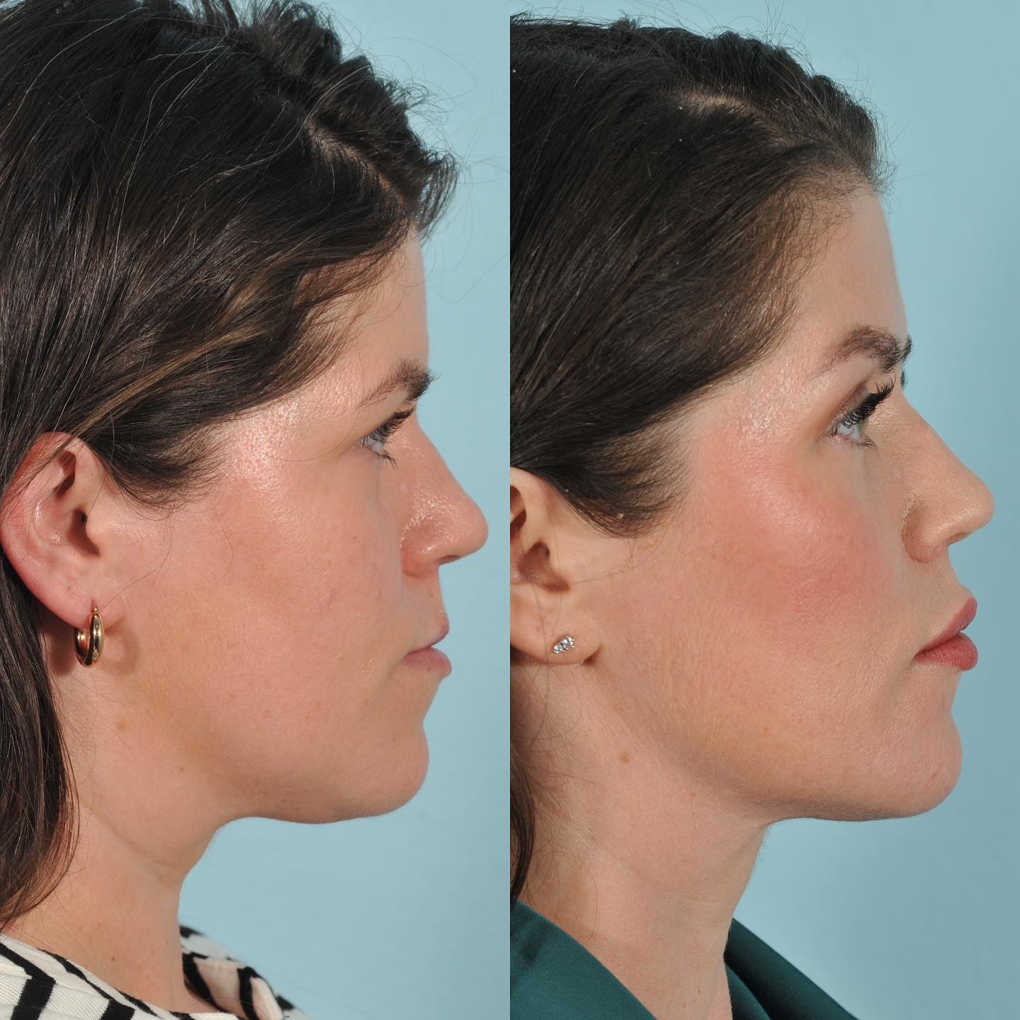 Injectables Before & After #12 image 3