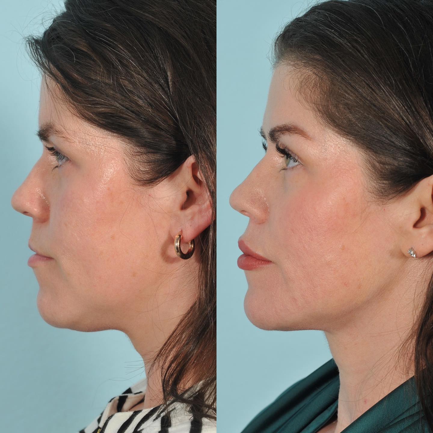 Injectables Before & After #12 image 2
