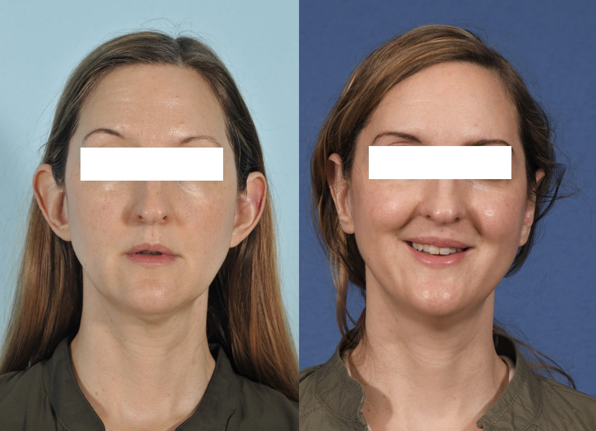 Otoplasty Before & After #1