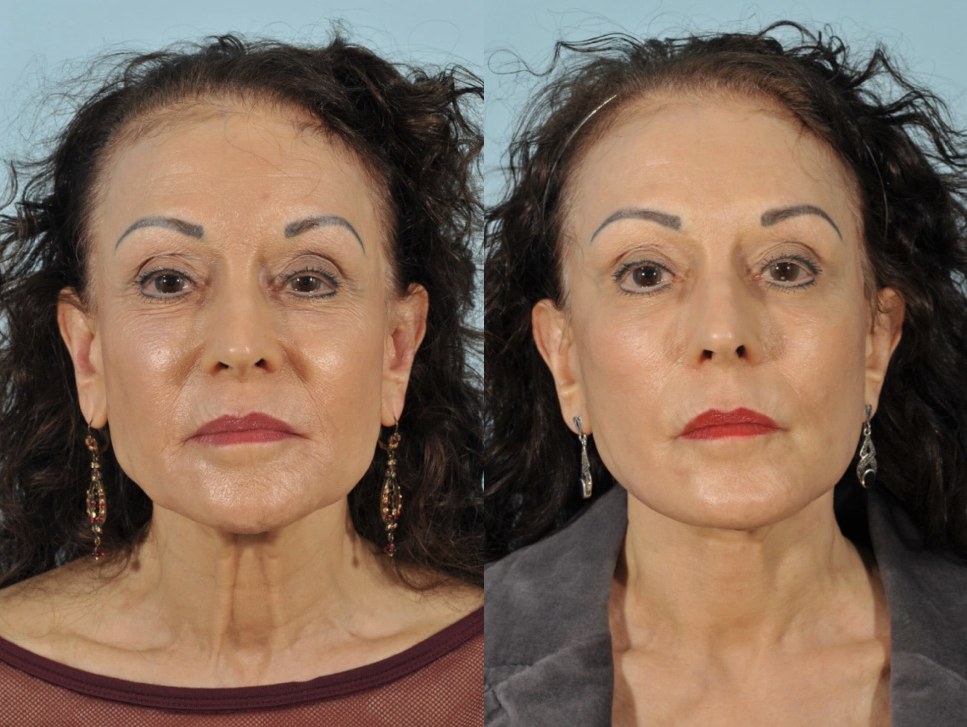 Facelift Before & After #2