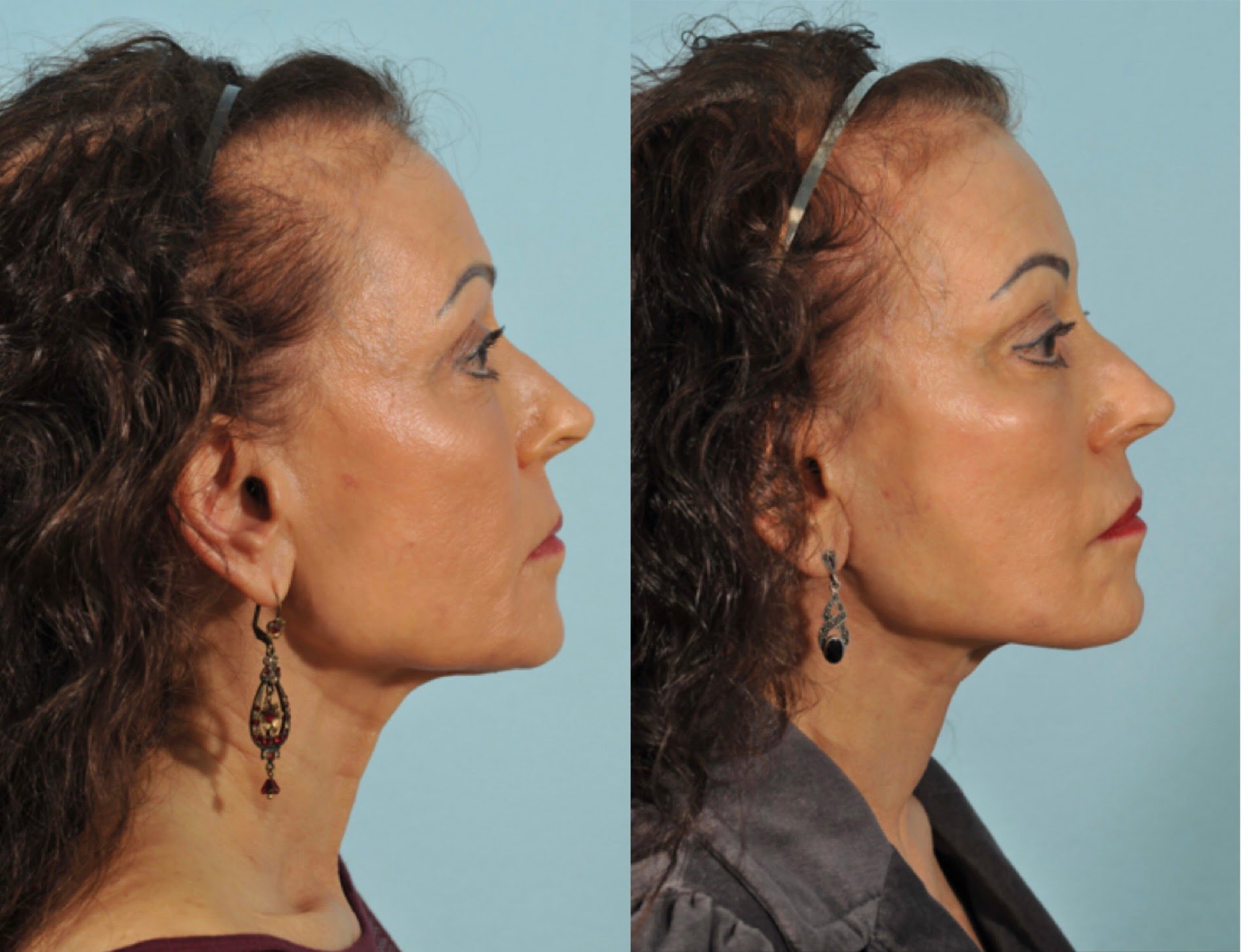 Facelift Before & After #2 image 2