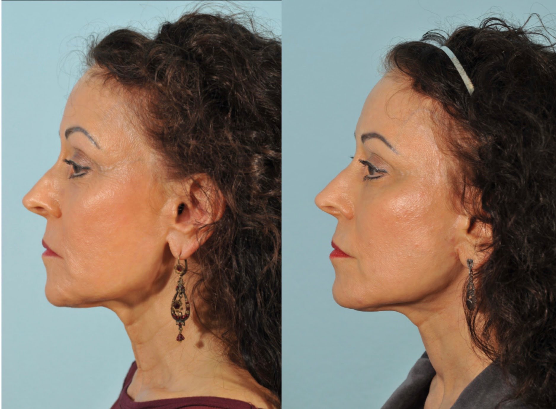 Facelift Before & After #2 image 5