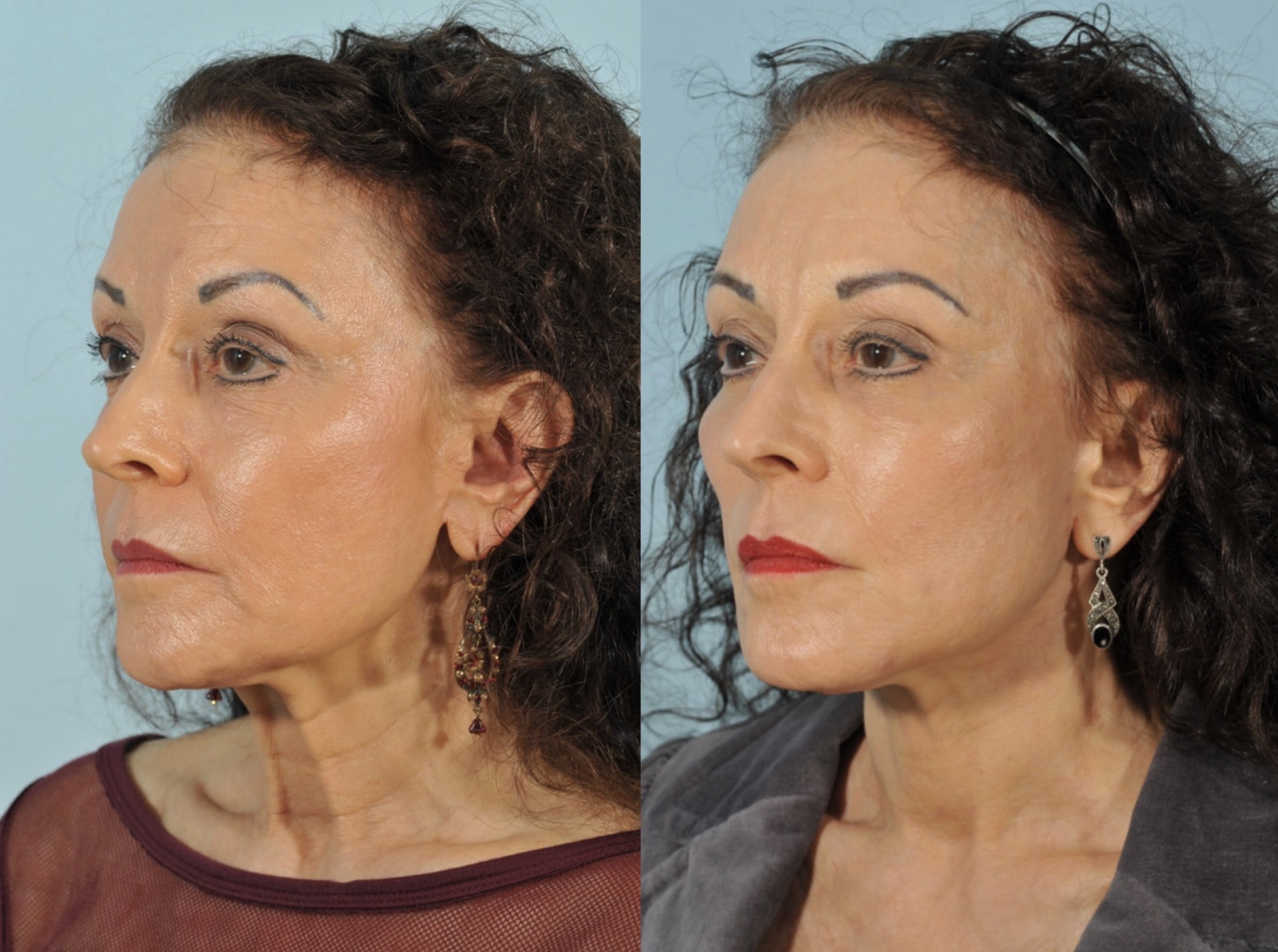 Facelift Before & After #2 image 3