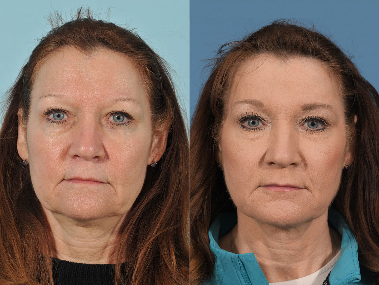 Injectables Before & After #13