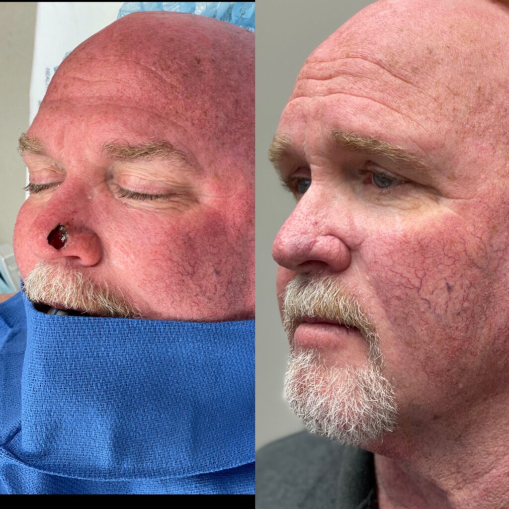 MOHS Reconstruction Before & After 2