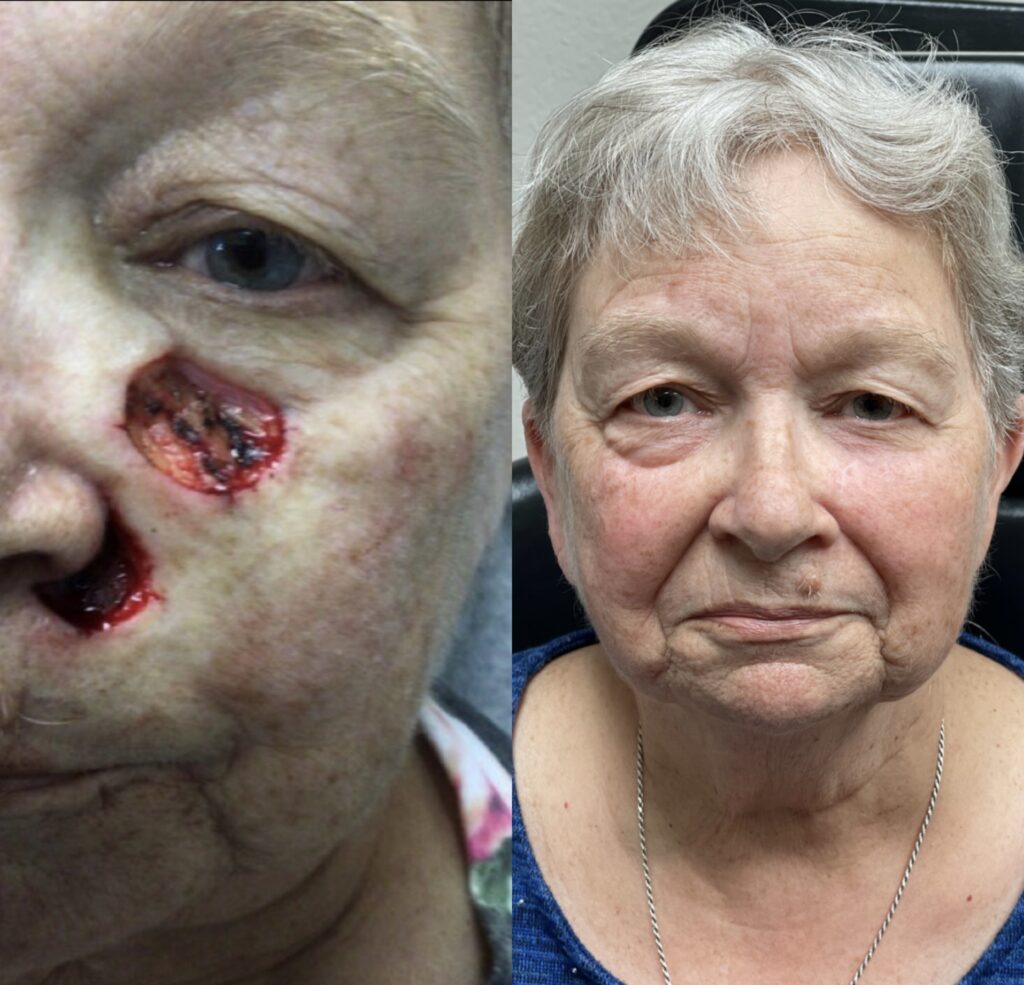 MOHS Reconstruction Before & After 1 before and after