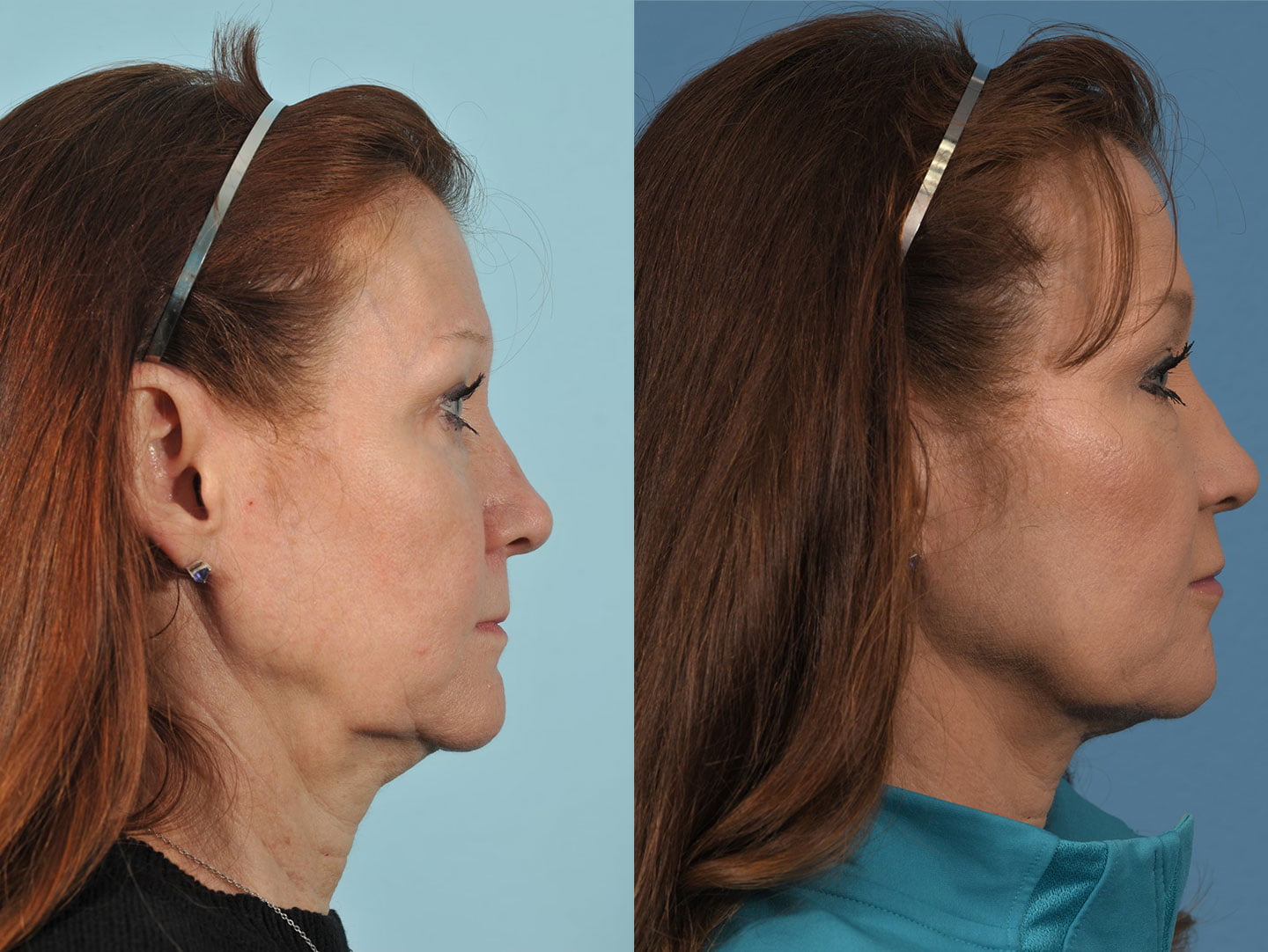 Injectables Before & After #13 image 2