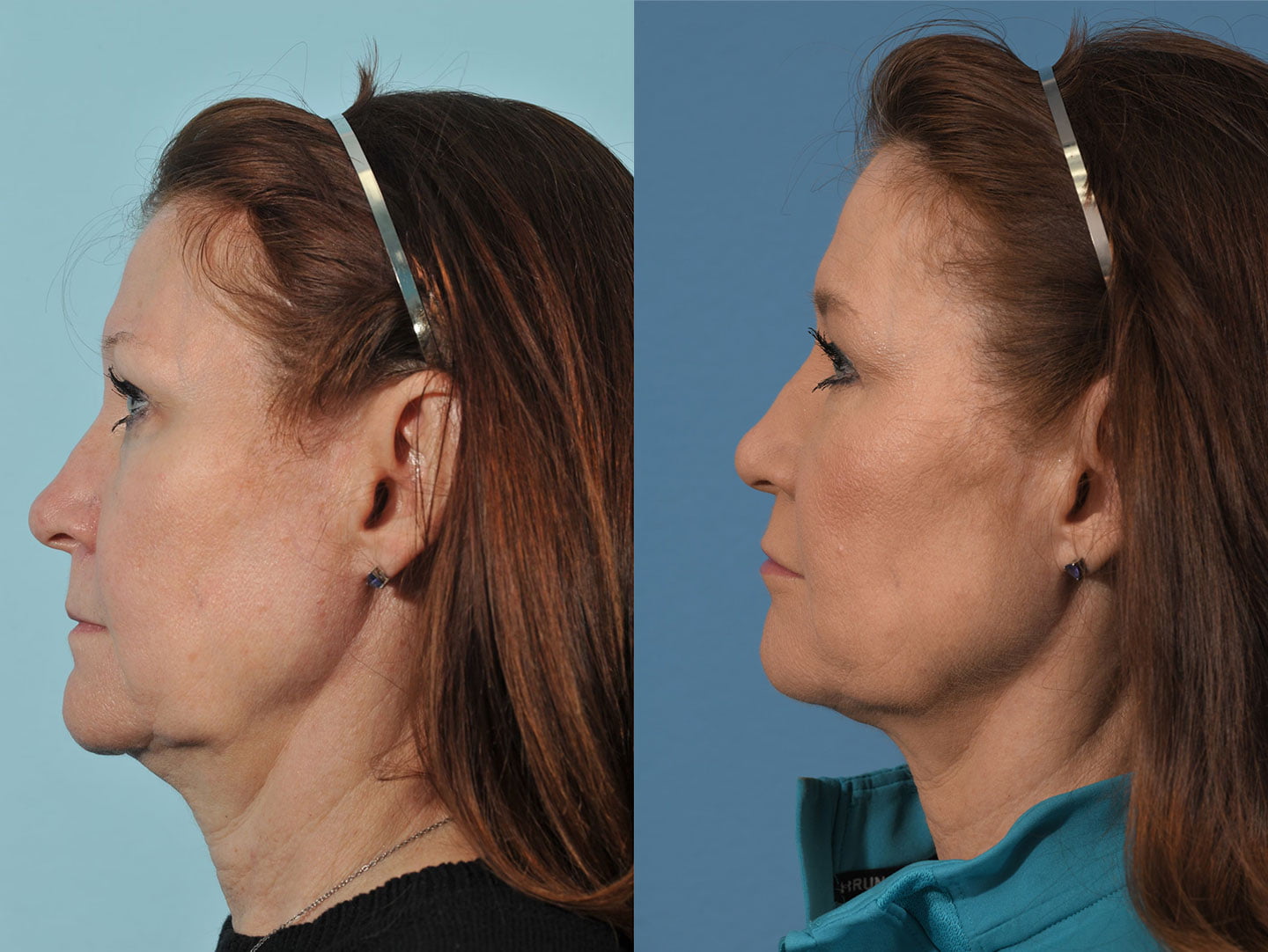 Injectables Before & After #13 image 3
