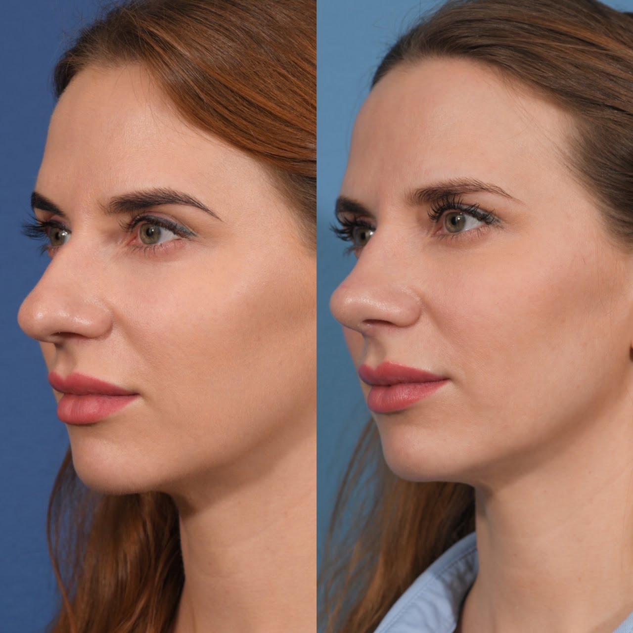 Preservation Rhinoplasty Before & After #18 image 2