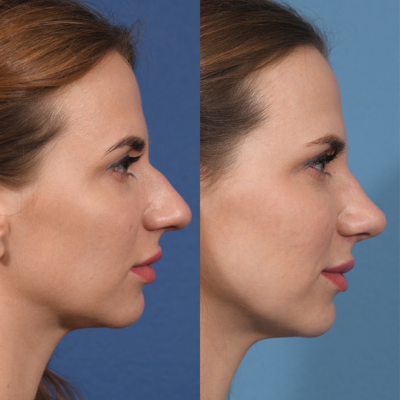 Preservation Rhinoplasty Before & After #18