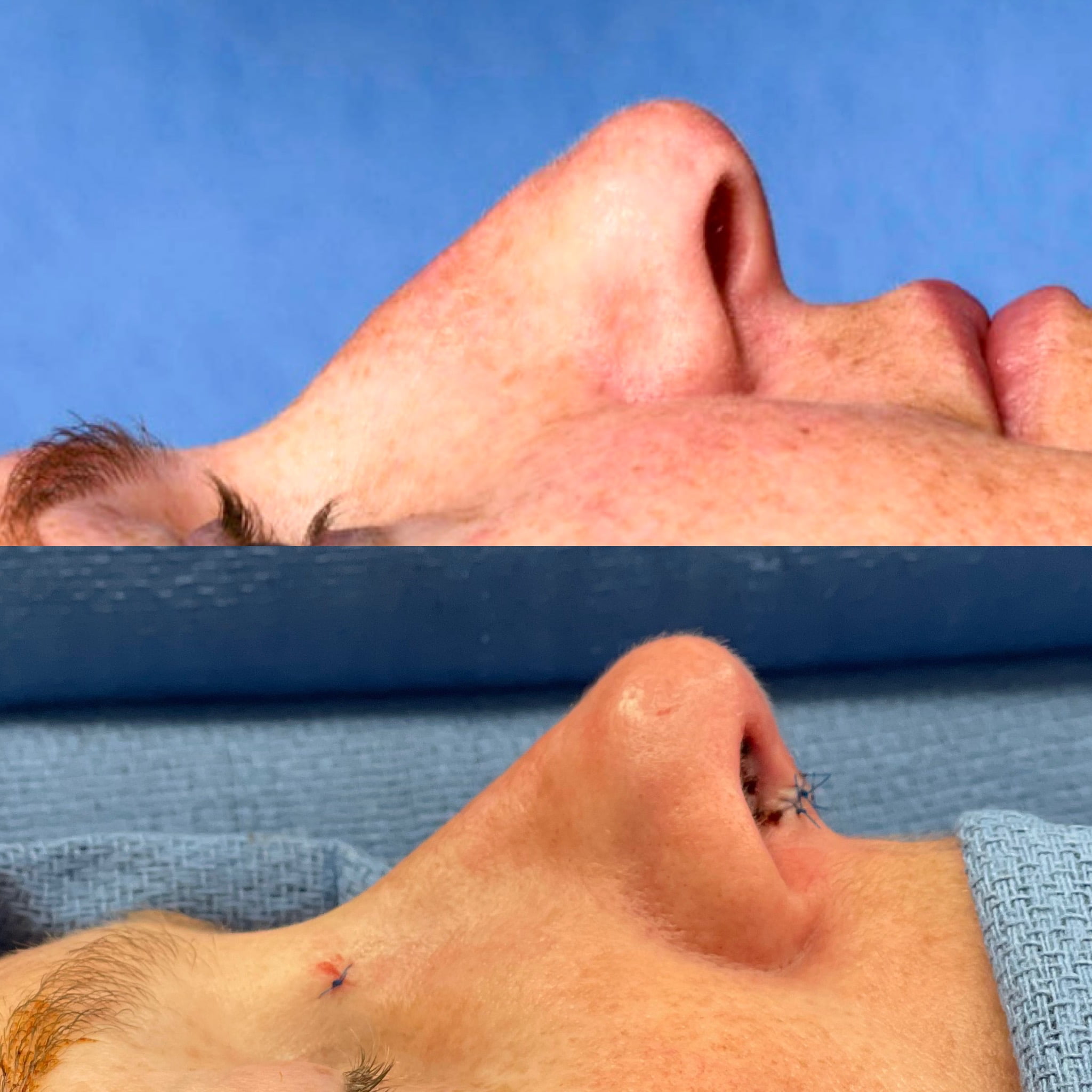 Preservation Rhinoplasty Before & After #19
