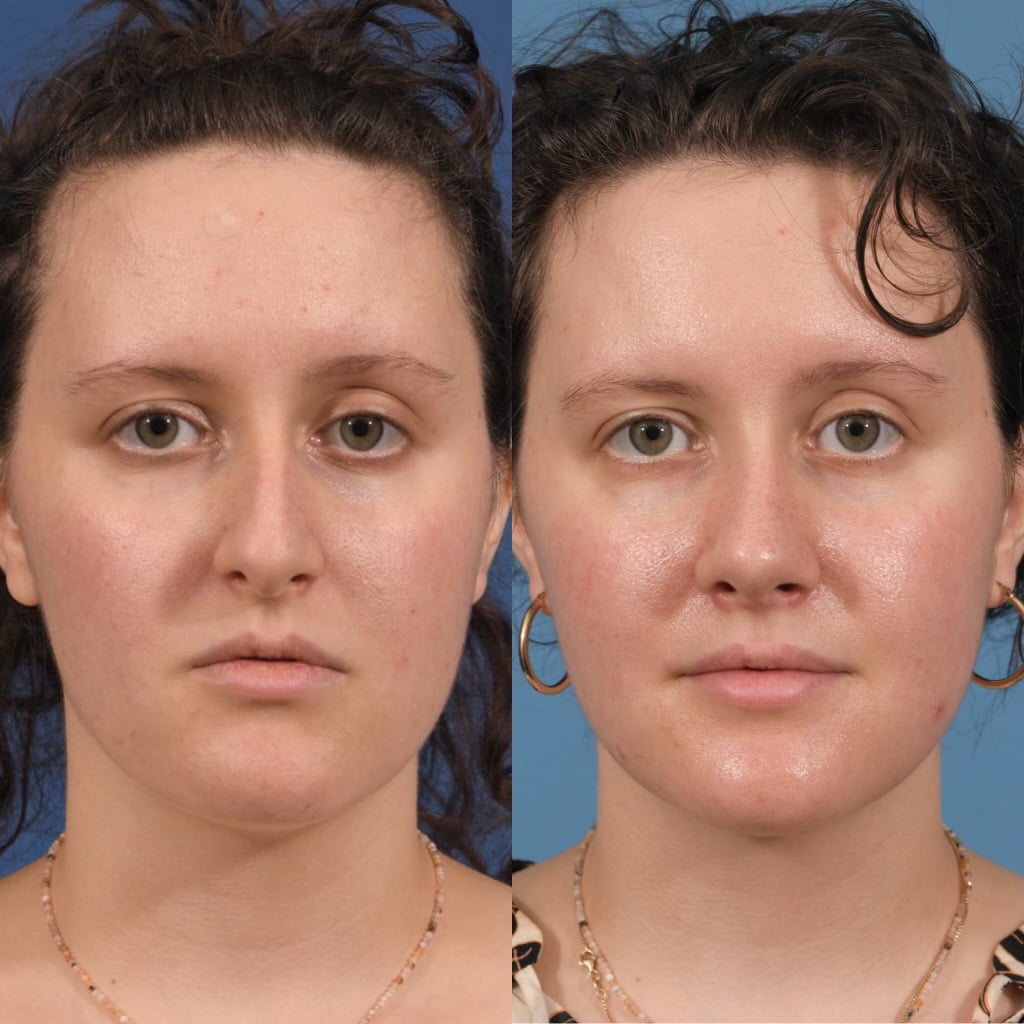 Septoplasty Before & After #20 image 5