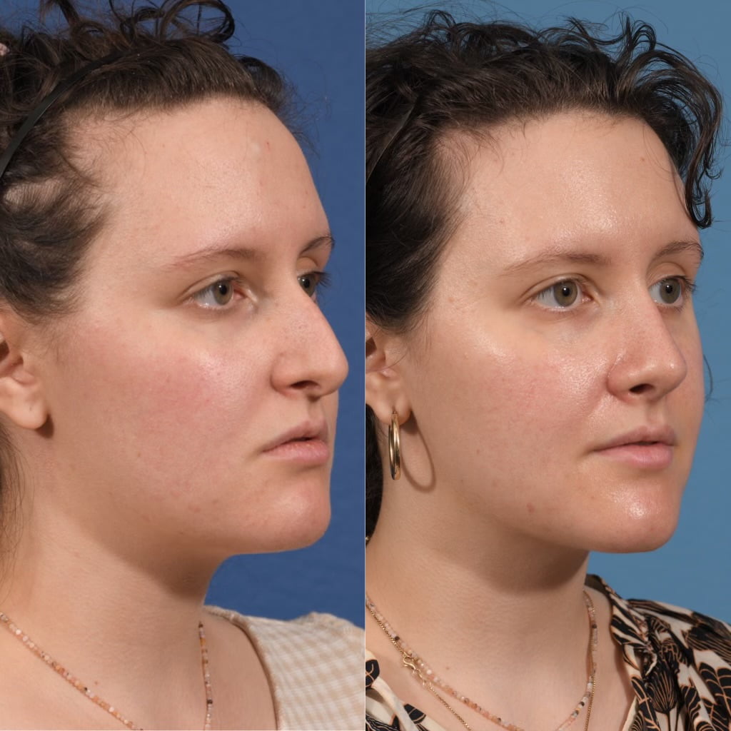 Septoplasty Before & After #20 image 2