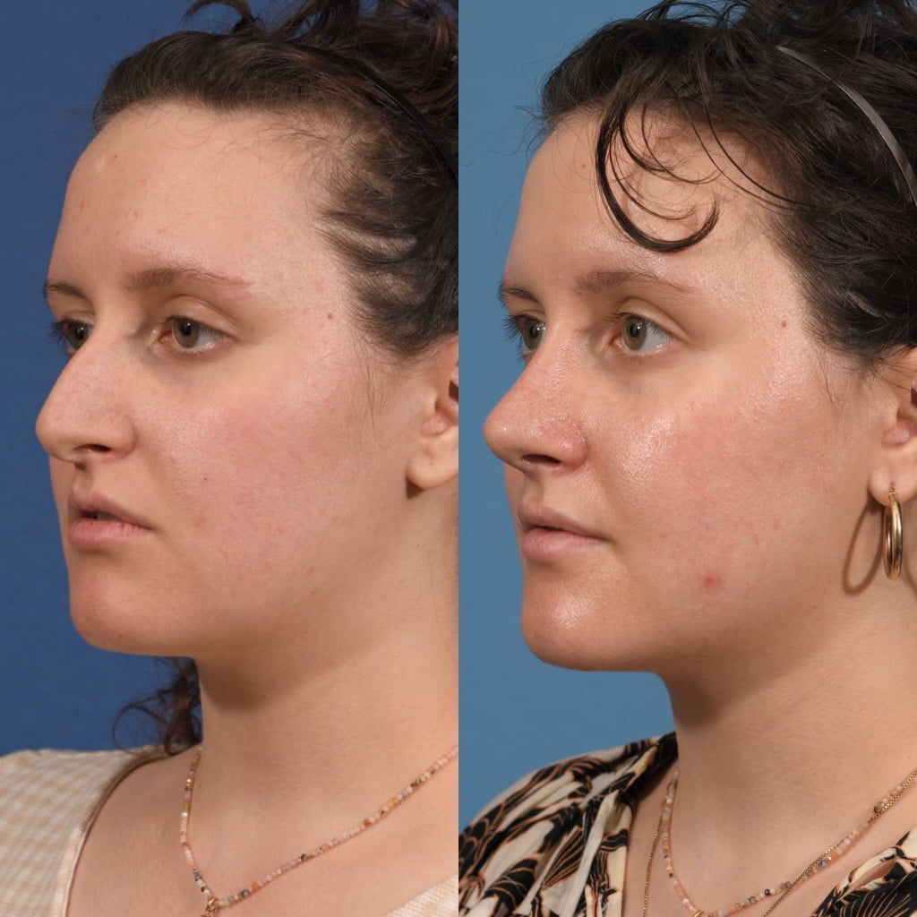 Septoplasty Before & After #20 image 3